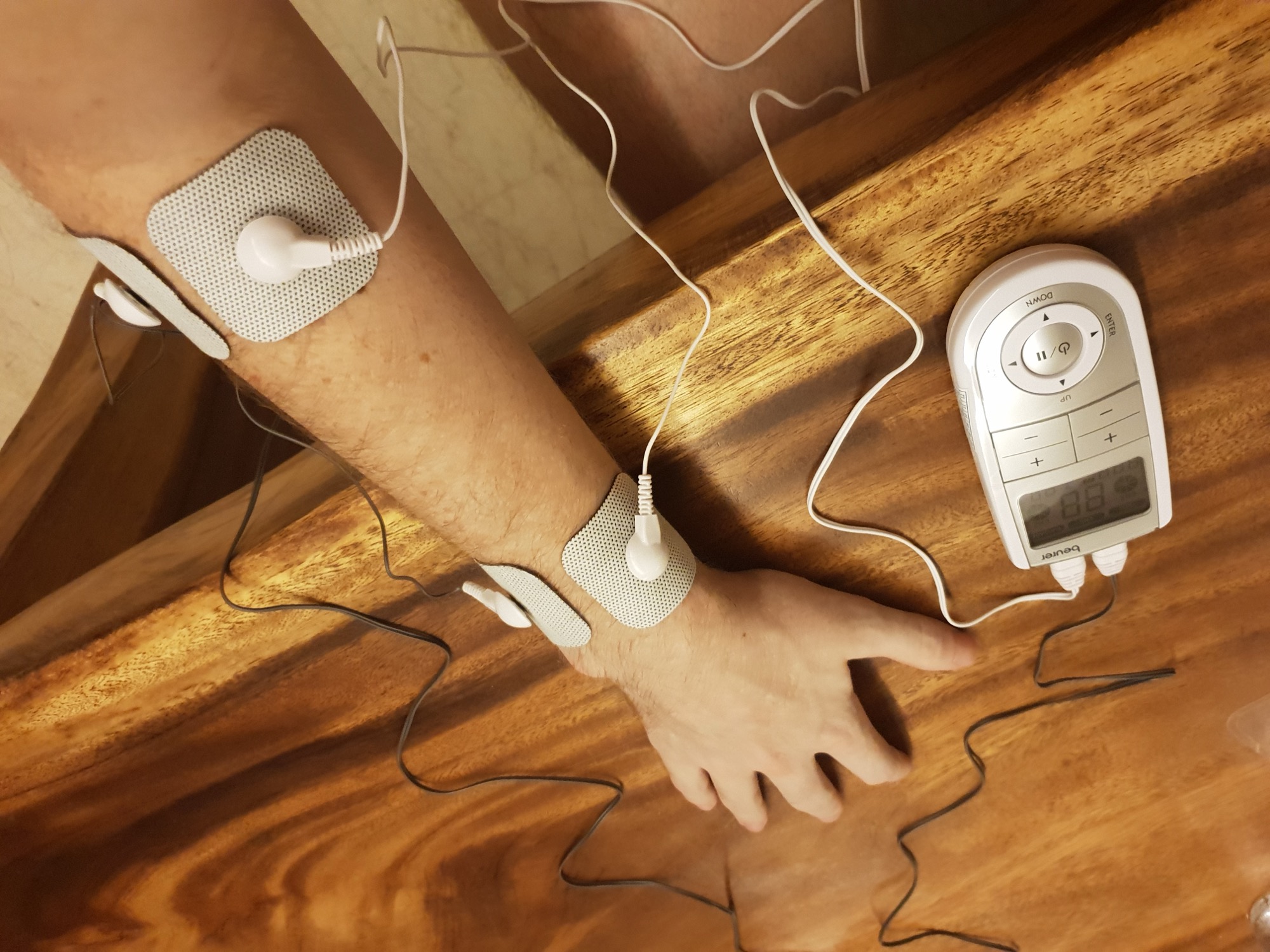 Keeping the lights on — electrical stimulation during the wait Keeping the lights on — electrical stimulation during the wait