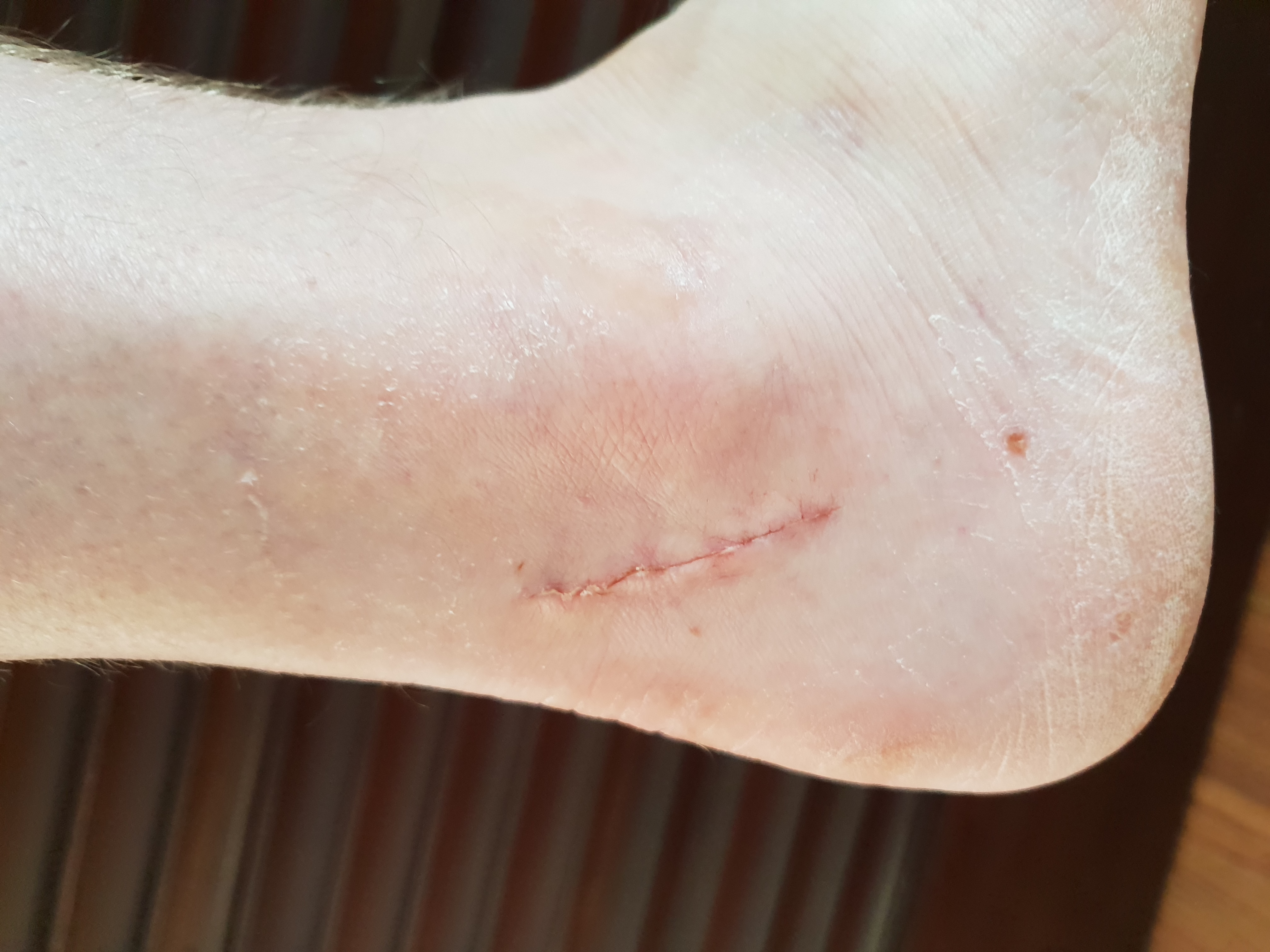 The ankle — where the sural nerve came out The ankle — where the sural nerve came out