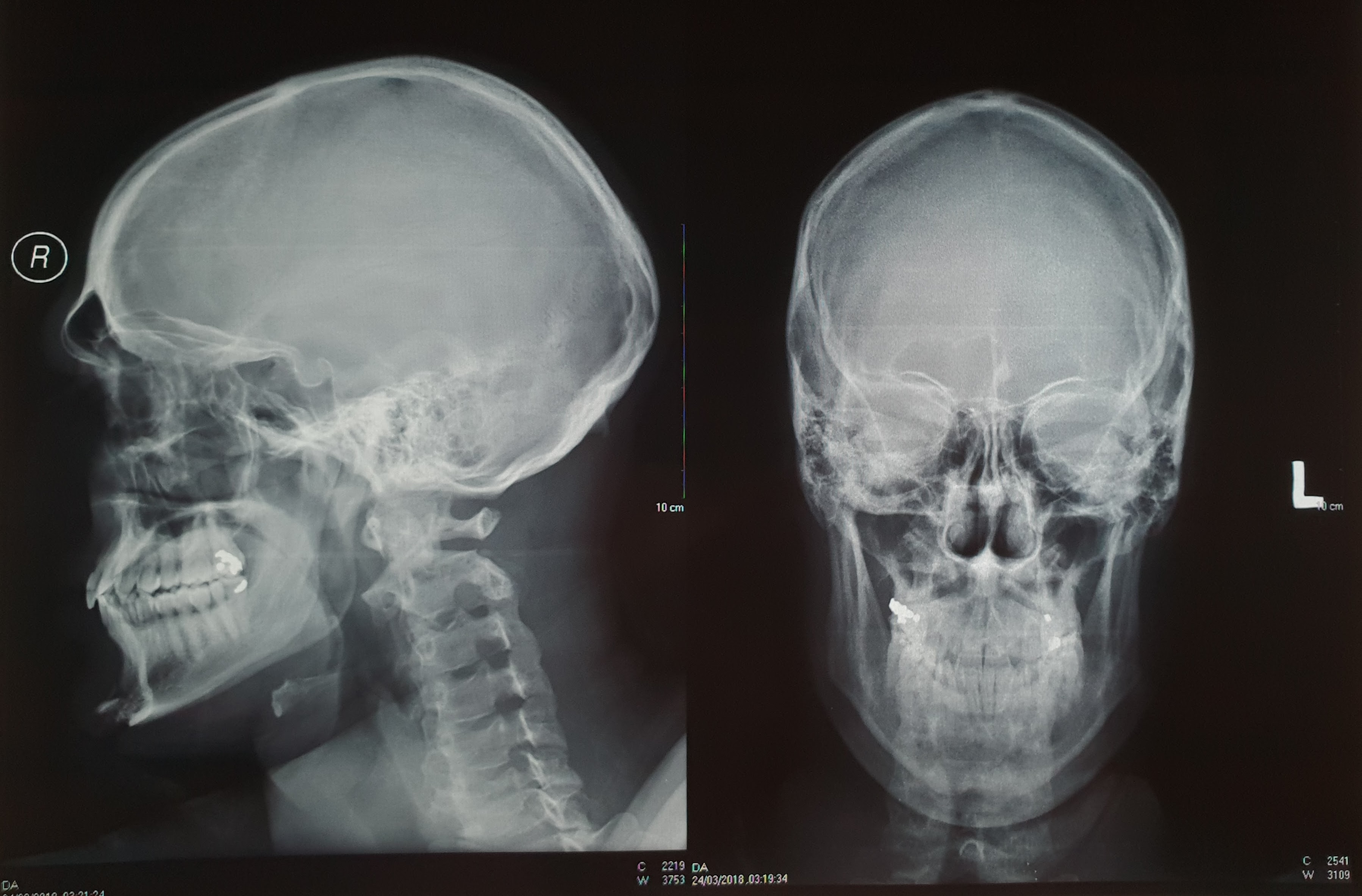 Chipped chin and barely chipped vertebrae. Chipped chin and barely chipped vertebrae.