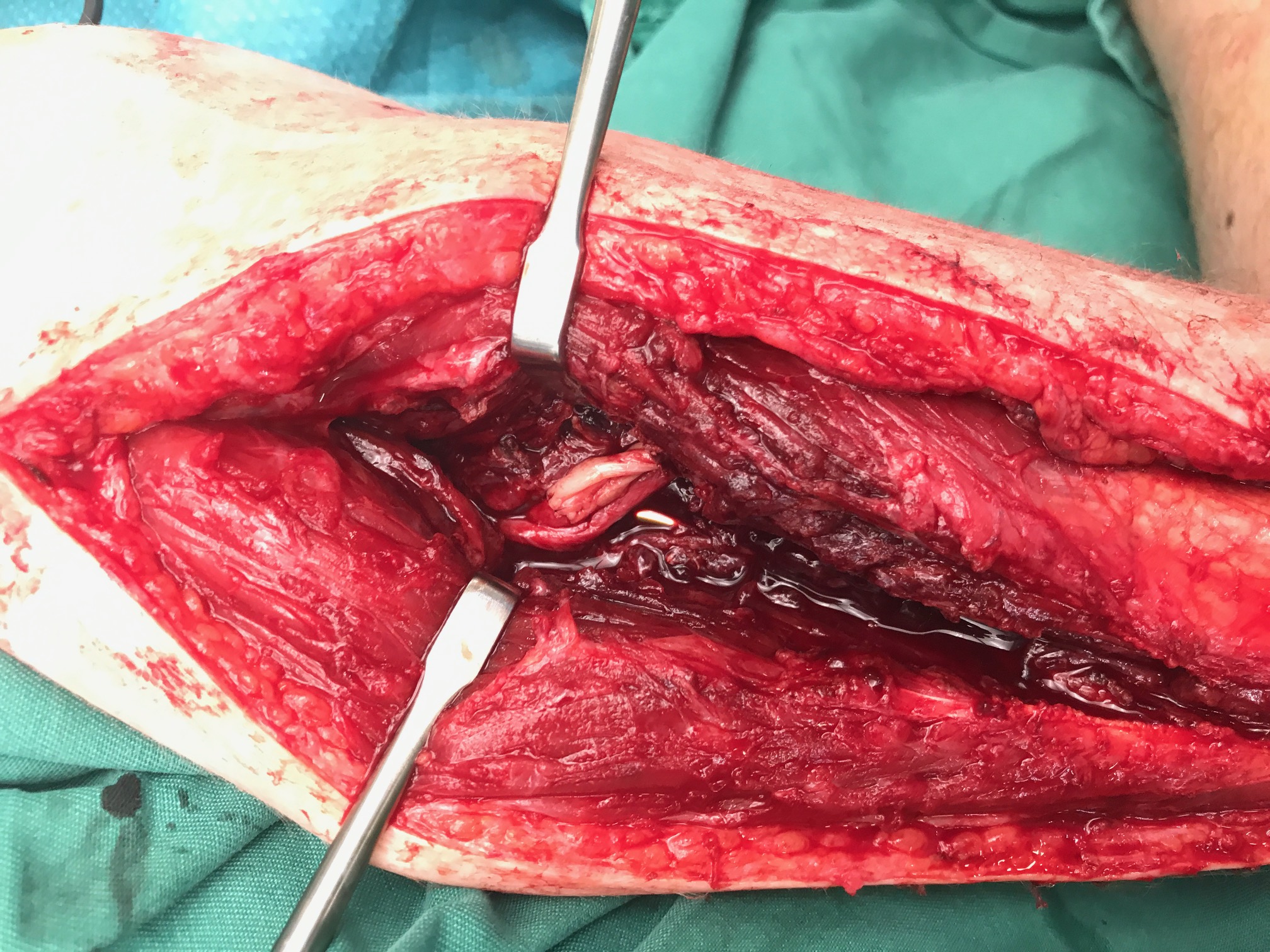 The cut end of the nerve — the pale cord in the middle The cut end of the nerve — the pale cord in the middle