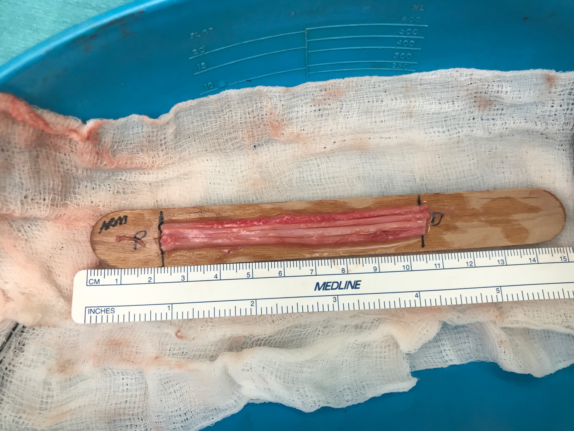 My sural nerve, out of my leg and cut into four 8 cm cables My sural nerve, out of my leg and cut into four 8 cm cables