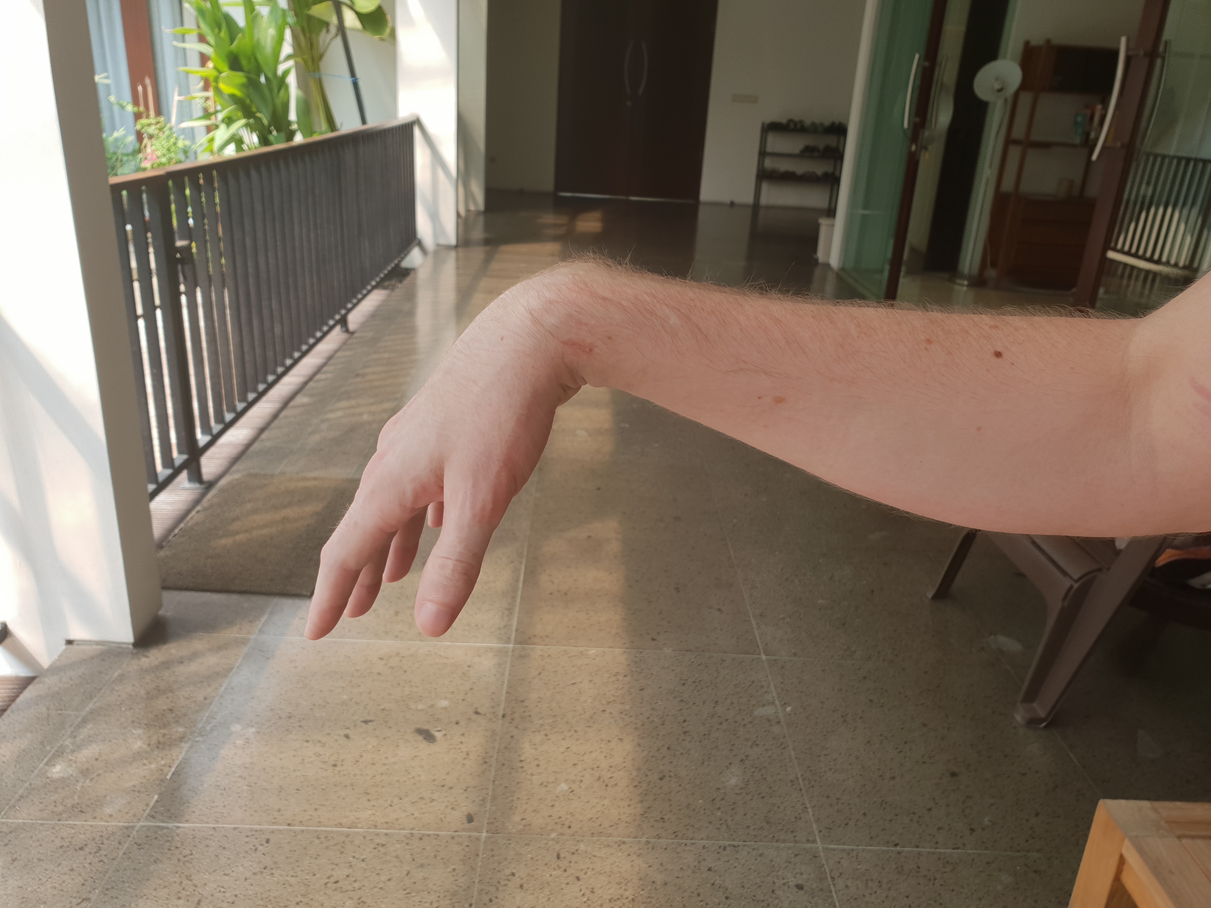 Wrist drop -- this is what the hand does on its own Wrist drop -- this is what the hand does on its own
